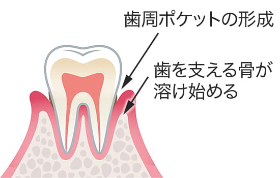 歯周ポケットの形成。歯を支える骨が溶け始める。